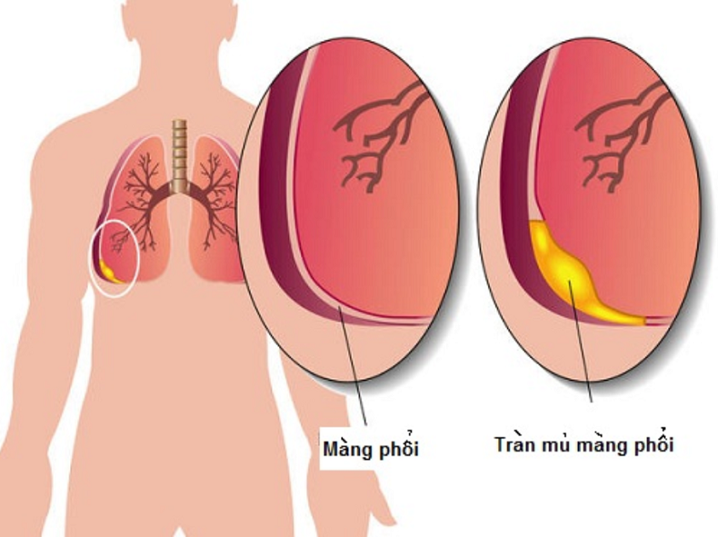 Biến chứng viêm mủ màng phổi